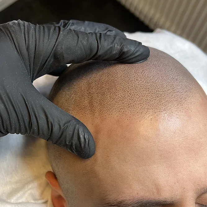 Efter Scalp Micropigmentation (SMP) behandling session 3