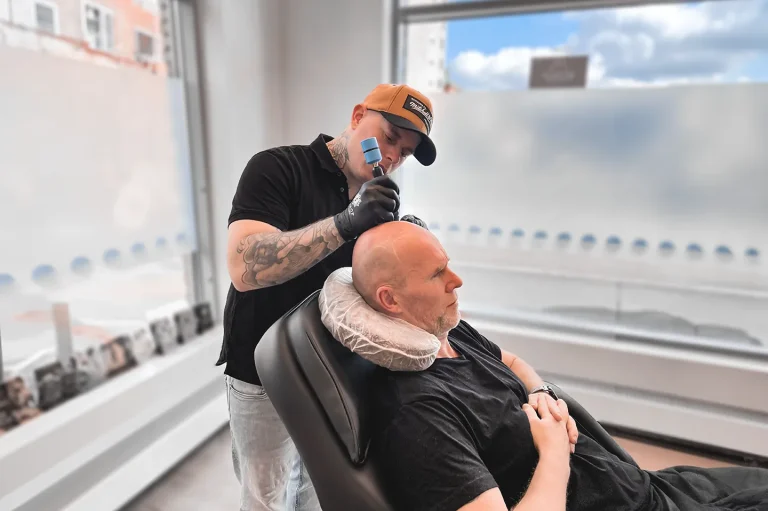 Efter Scalp Micropigmentation (SMP) behandling session 3